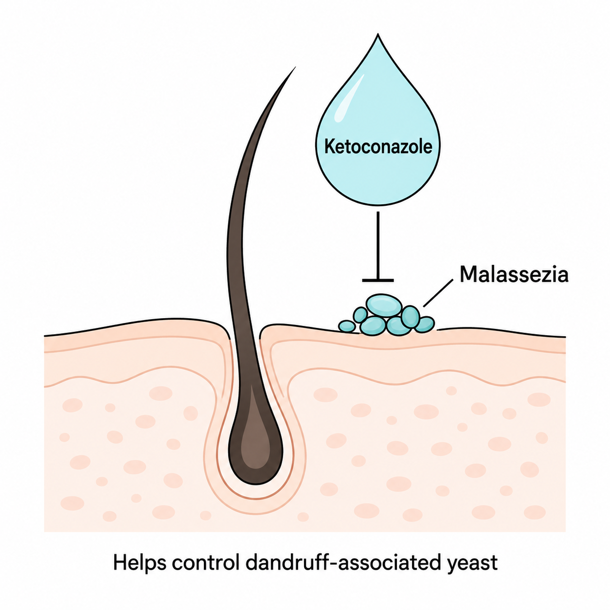 Diagram showing ketoconazole inhibiting Malassezia yeast on the scalp
