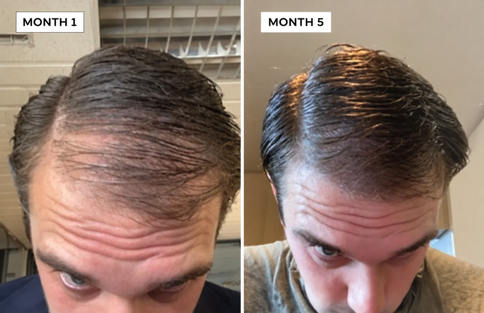 User-provided hair comparison, month 1 and month 5