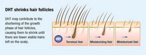 Hair loss explained by Baltimore hair transplant doctor Jeffrey E  Schreiber MD FACS
