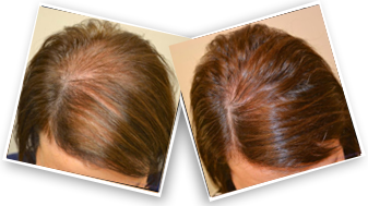 Women's Minoxidil Spray 5% For Hair Treatment Spray
